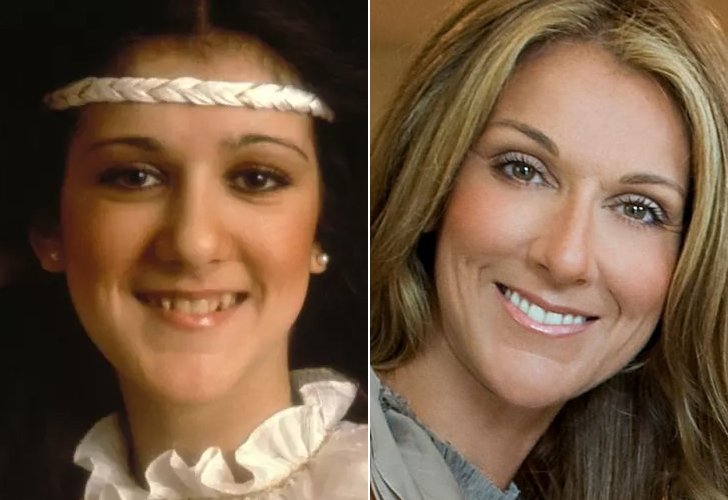CELEBS WITH BAD TEETH - HOW FAR DID THEY GO? THEIR DENTAL IMPLANTS COST