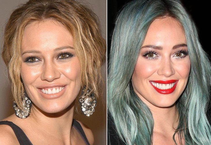 CELEBS WITH BAD TEETH - HOW FAR DID THEY GO? THEIR DENTAL IMPLANTS COST