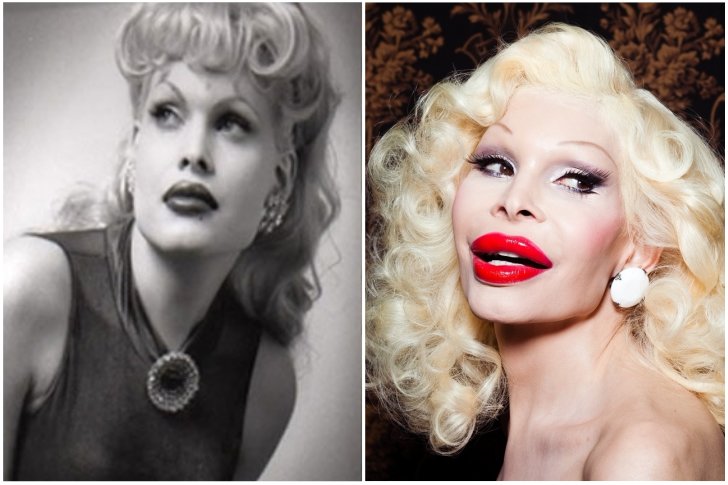 Amanda Lepore chirurgie esthétique