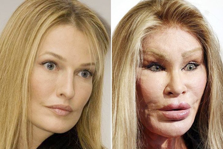 Jocelyn Wildenstein aesthetic surgery