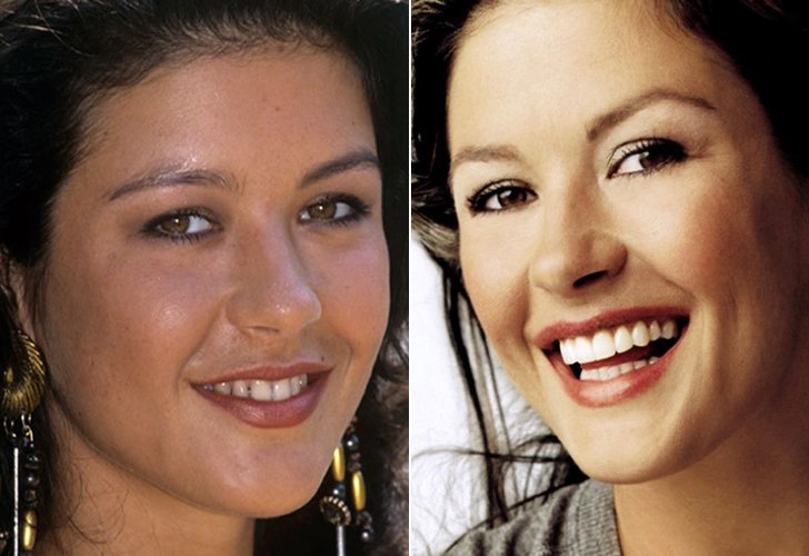 CELEBS WITH BAD TEETH - HOW FAR DID THEY GO? THEIR DENTAL IMPLANTS COST ...