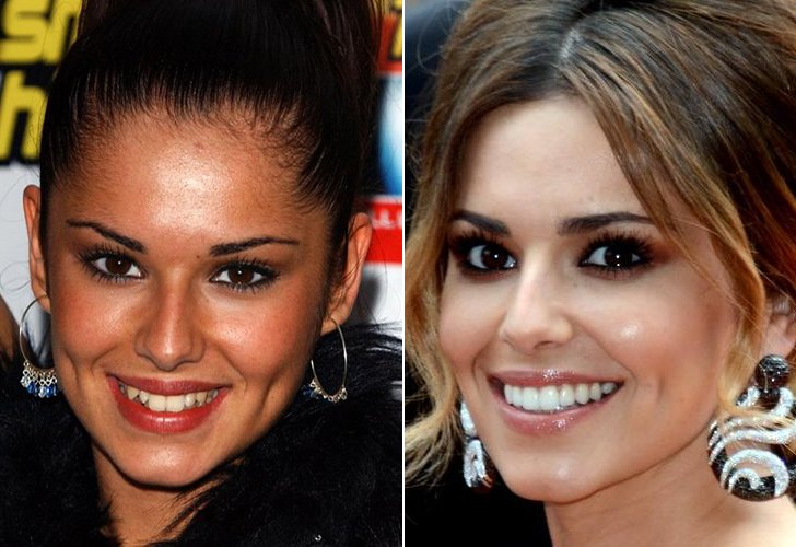 CELEBS WITH BAD TEETH - HOW FAR DID THEY GO? THEIR DENTAL IMPLANTS COST ...